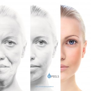 Peeling Nijkerk senseforbeautyandfeet